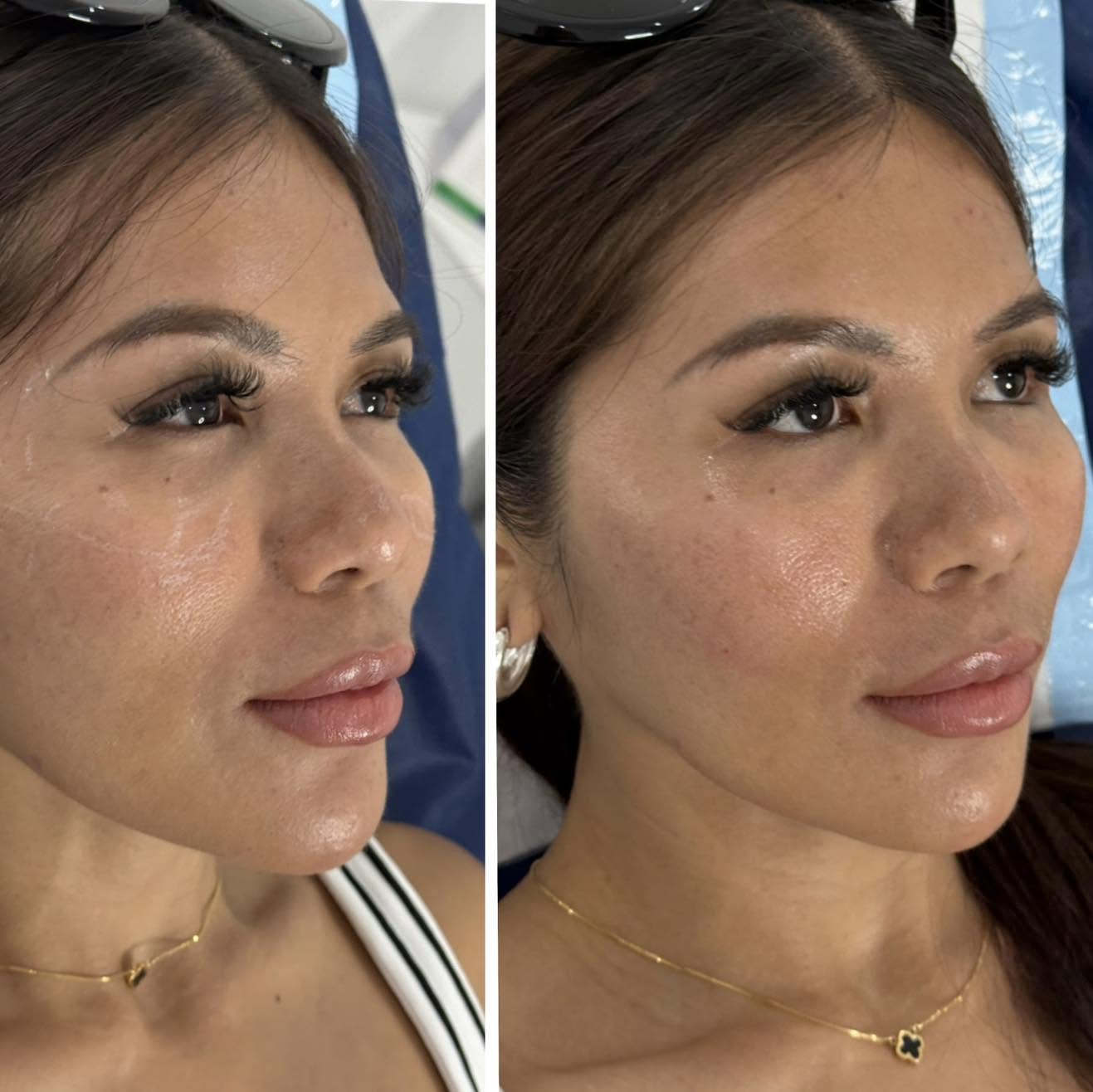 Before and after photograph showing skin clarity and tone.