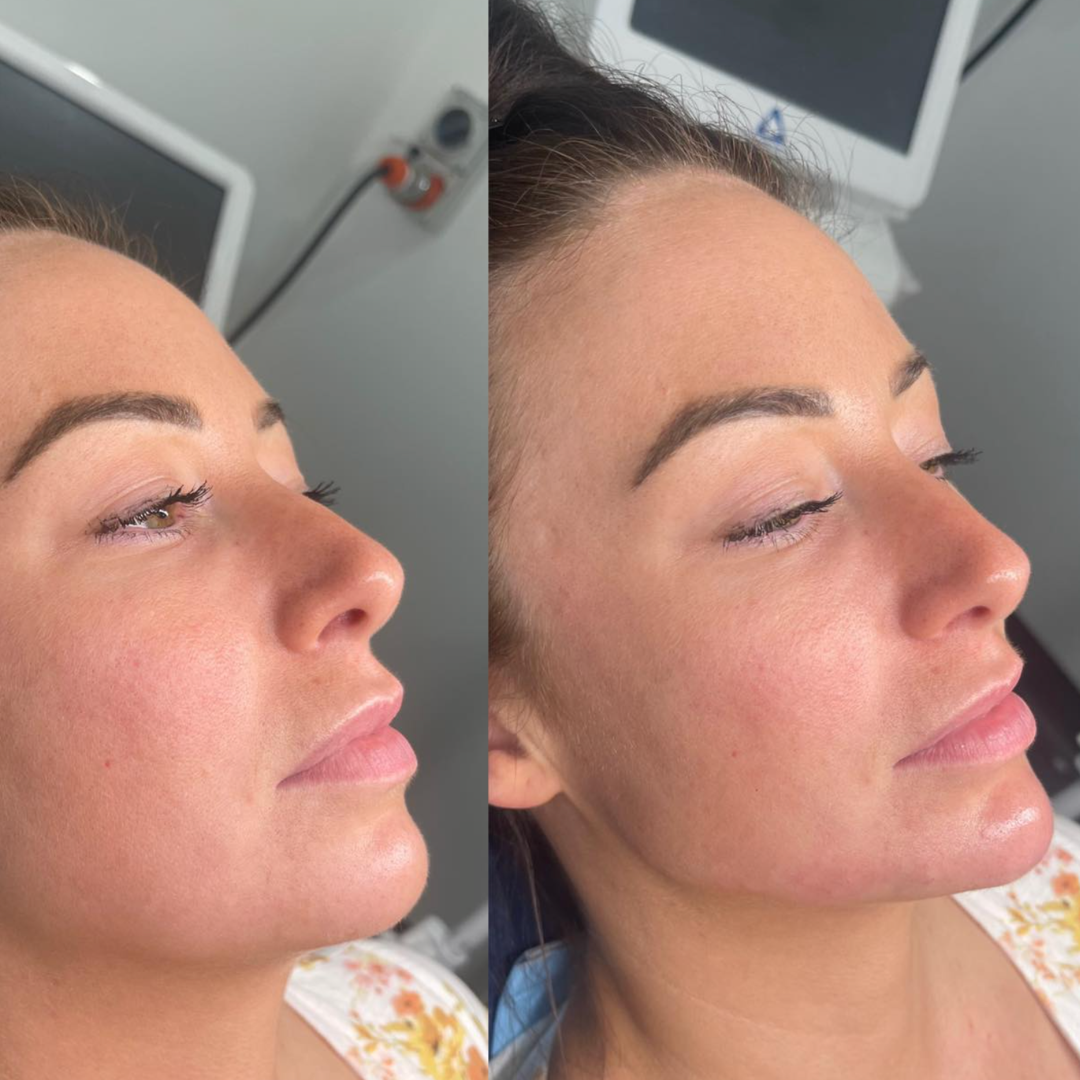 Before and after side-profile photograph showing chin balance.