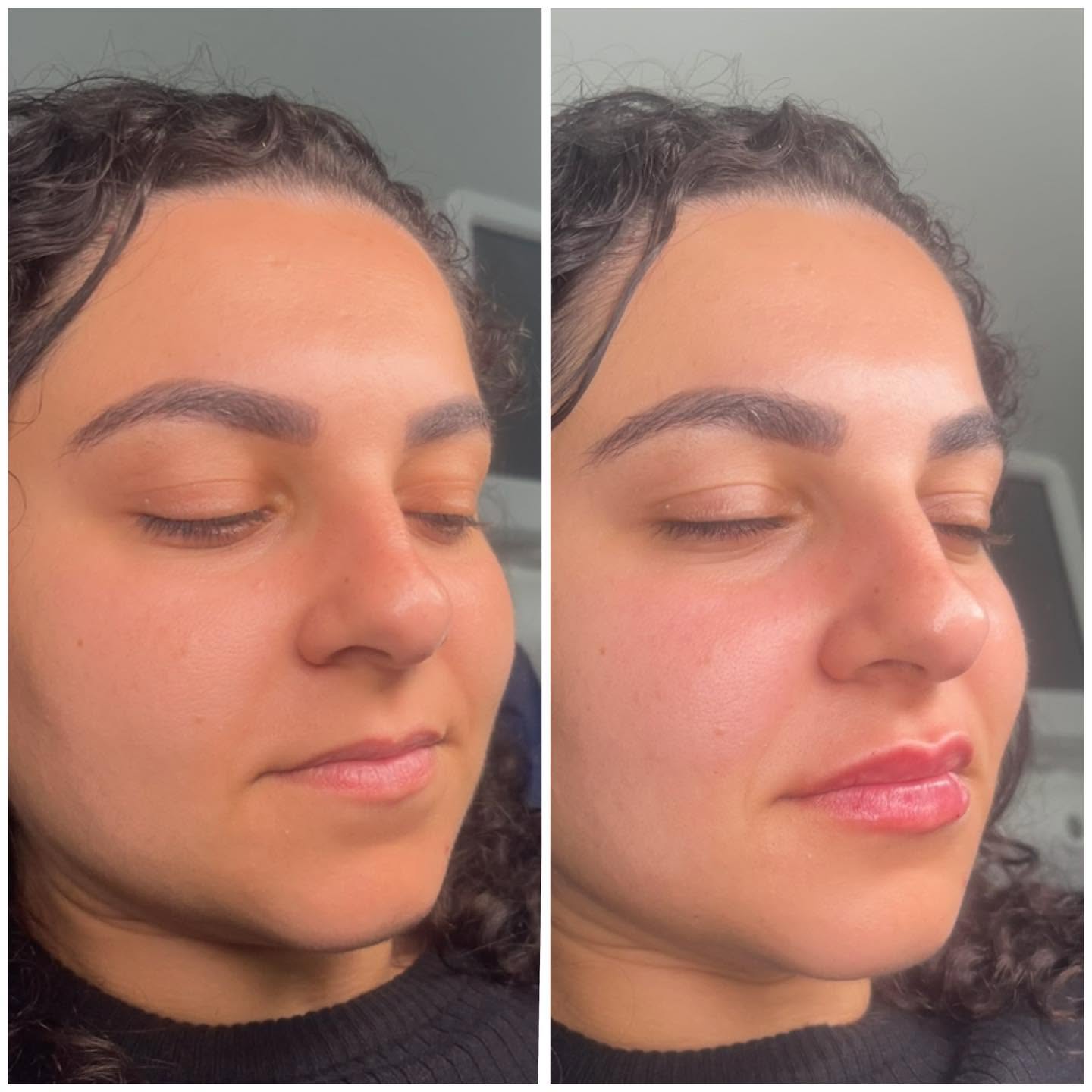 Before and after photograph showing lip balance from a three-quarter profile view.