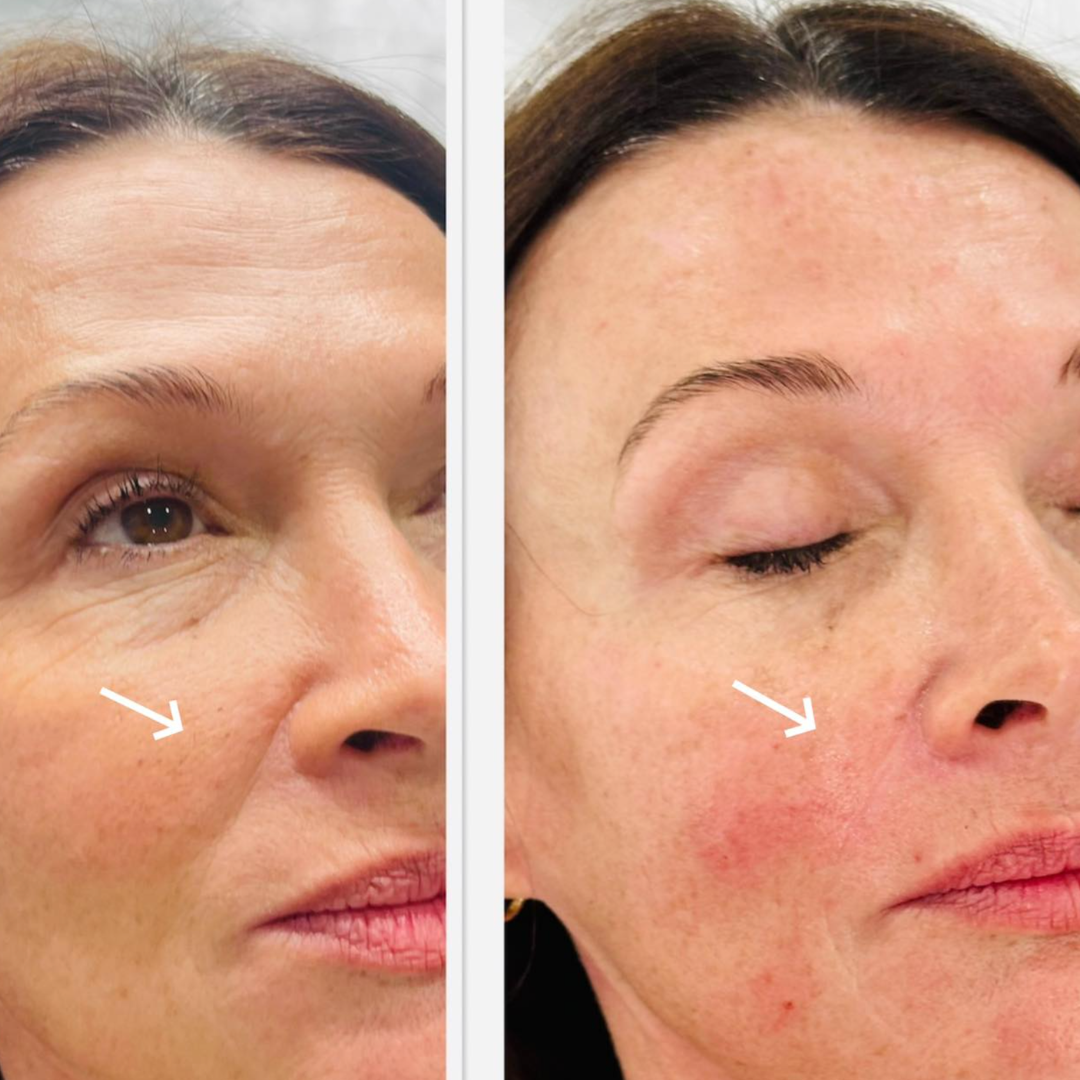 Before and after photograph of the under-eye area.