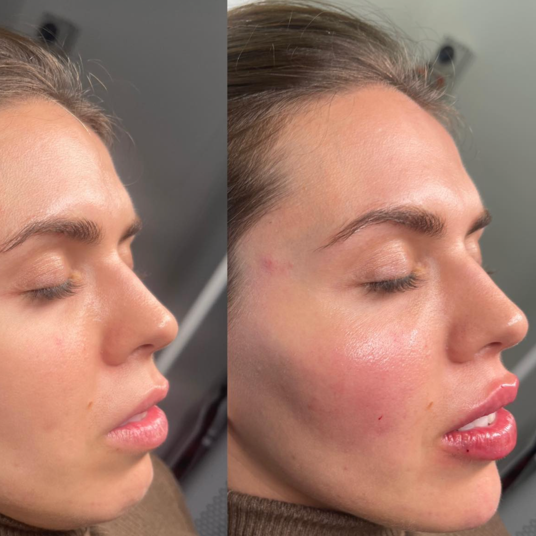 Before and after side-profile photograph showing cheek projection.