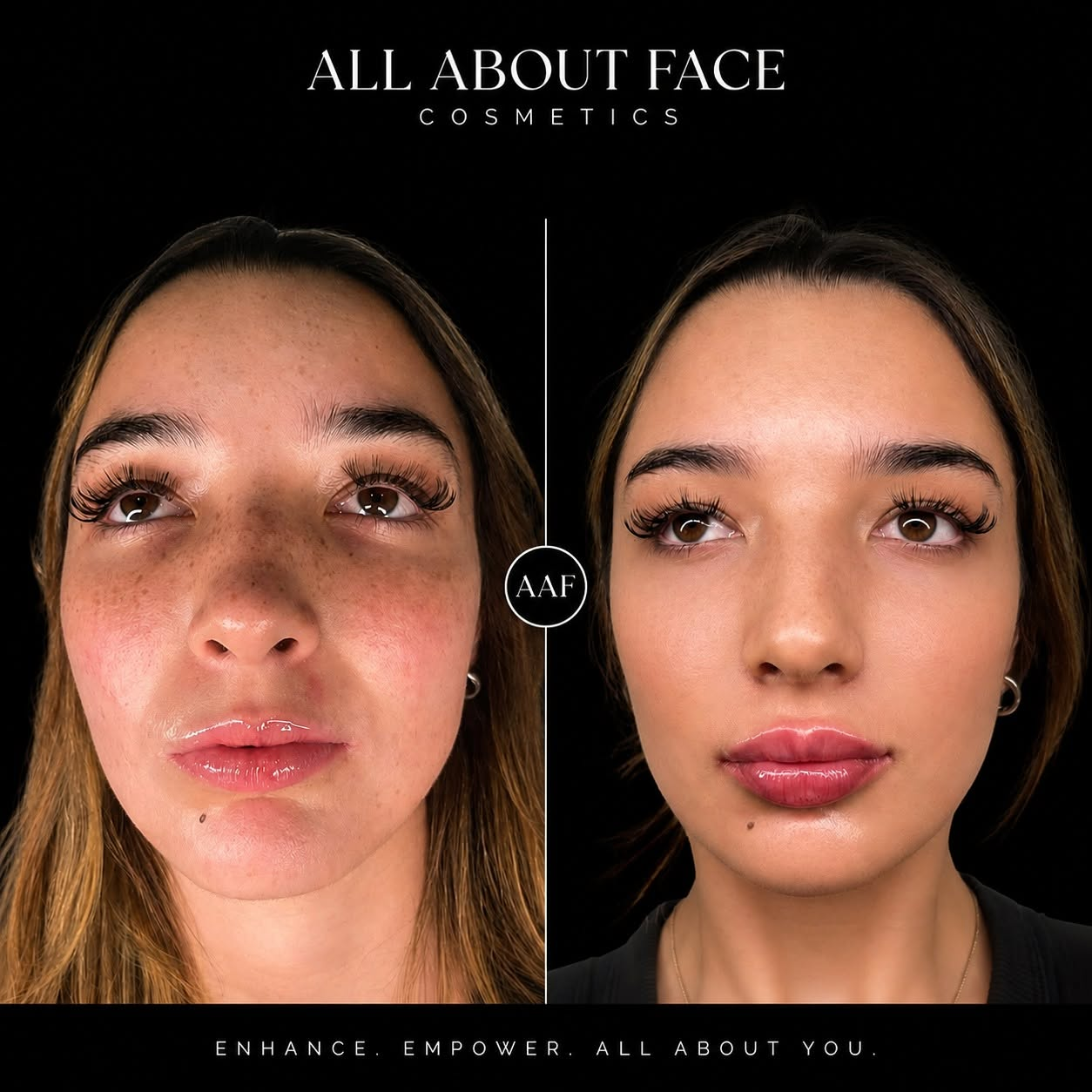 Before and after photograph of the skin around the mouth and lips.